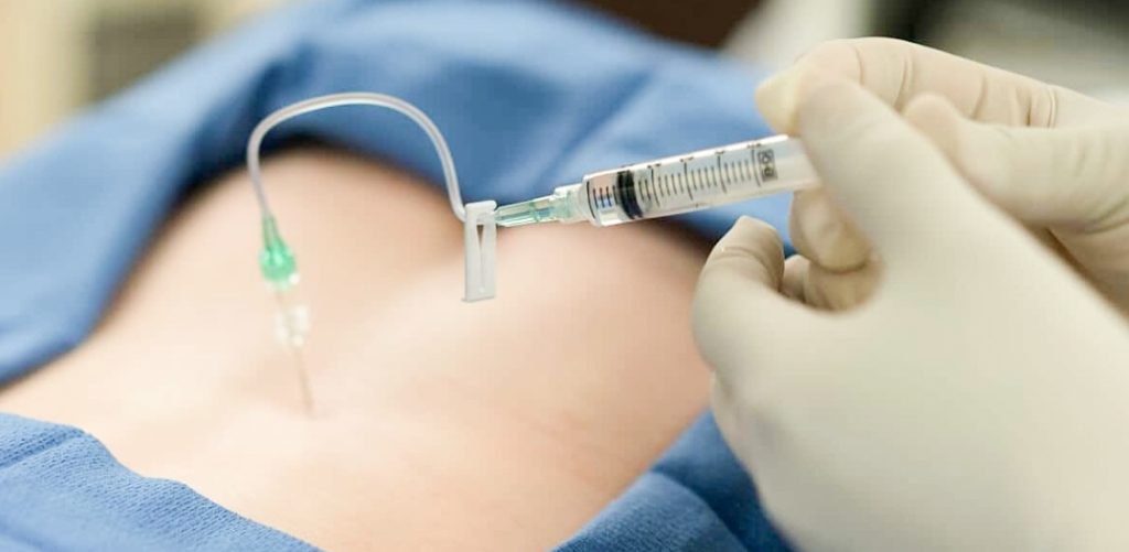 Understanding About How Epidural Steroid Injections Work